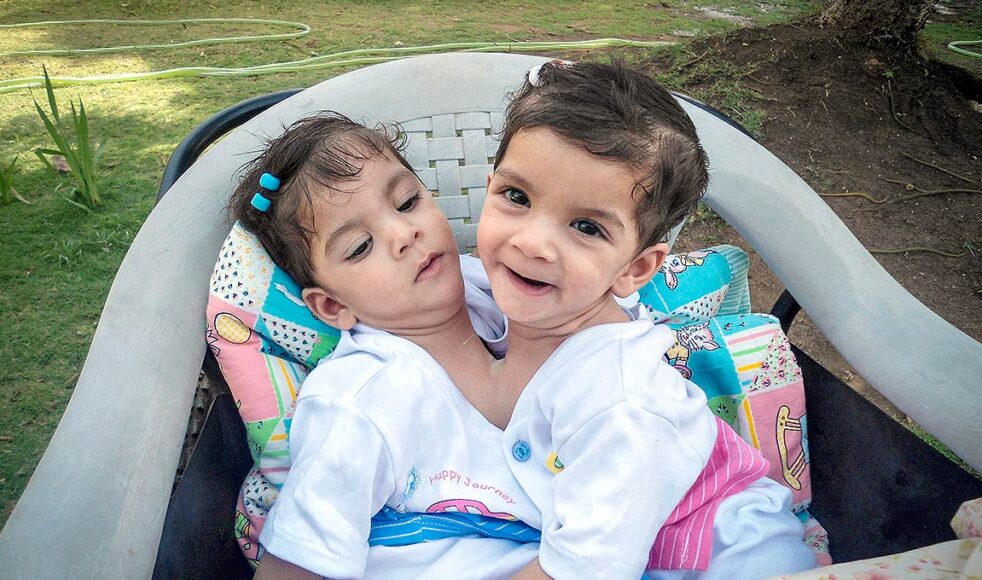 Stuti och Aradhana föddes med sammanväxta bröstkorgar och opererades på sjukhuset i Padhar. Bild: Privat